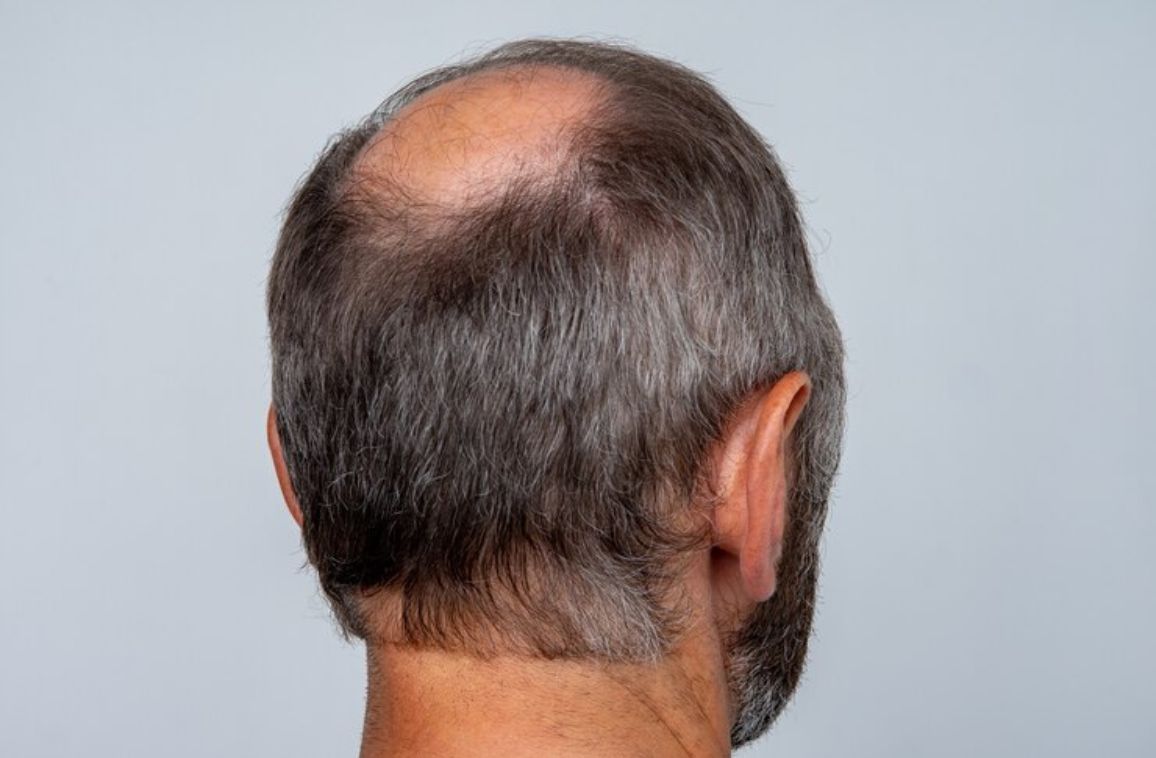 Preventing Premature Balding: Tips for Healthy Hair